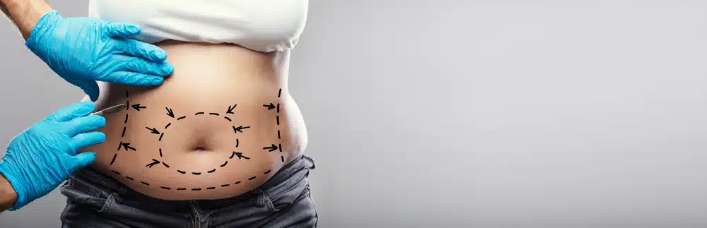 Consider These Tummy Tuck Risks Before an Abdominoplasty Procedure